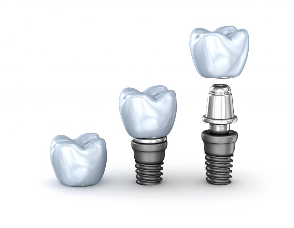 ventajas de los implantes dentales